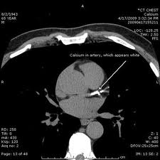 Coronary Calcium
