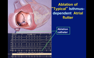 Catheter ablation of atrial flutter