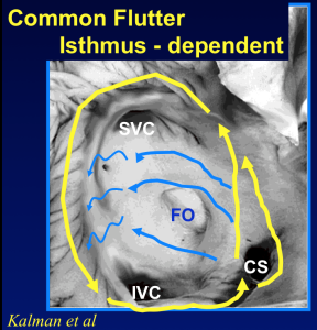 Typical right atrial flutter