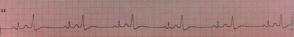 Benign Pvcs A Heart Rhythm Doctor S Approach