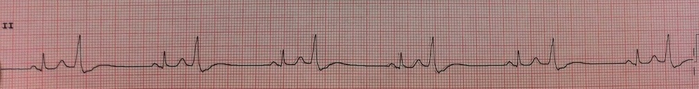 Benign Pvcs A Heart Rhythm Doctor S Approach Benign Pvcs A Heart Rhythm Doctor S Approach