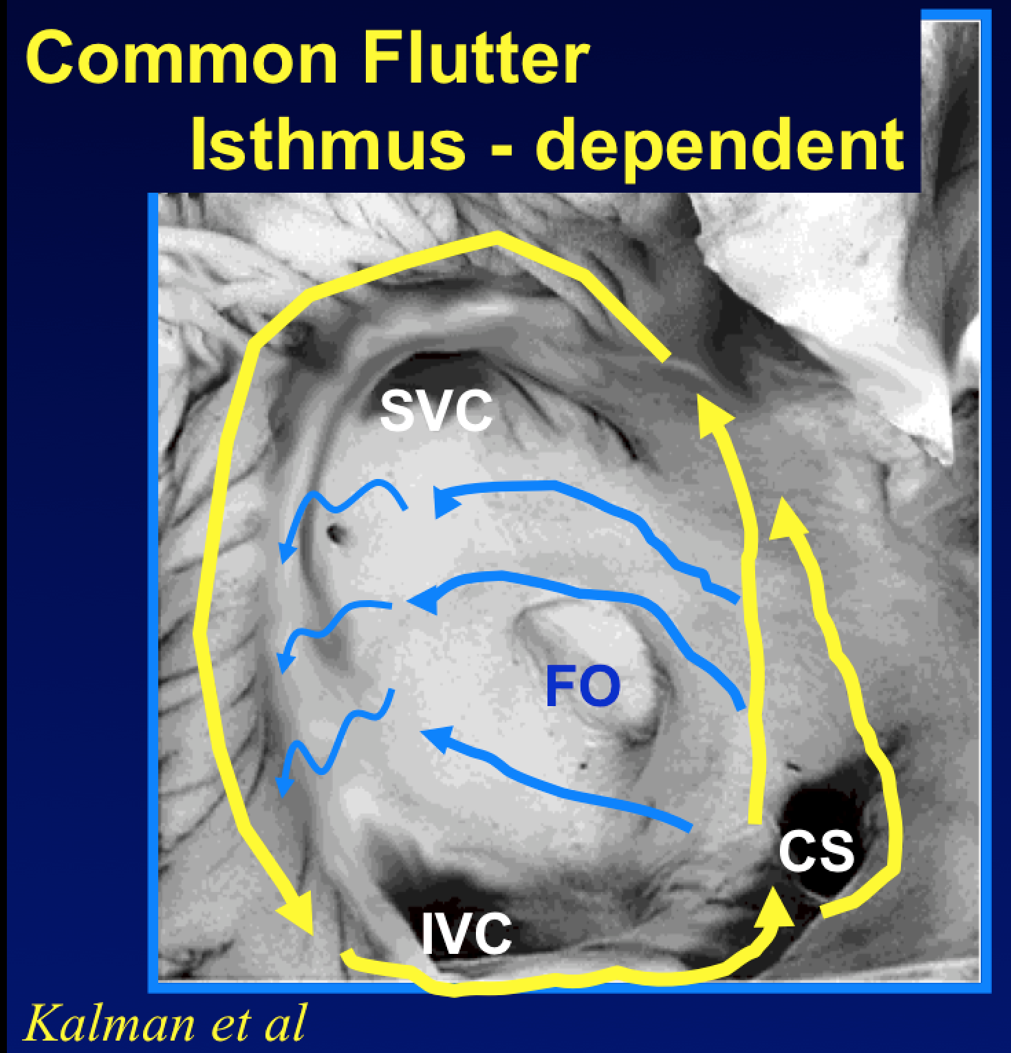 Atrial Flutter — 15 facts you may want to know. – Dr John M