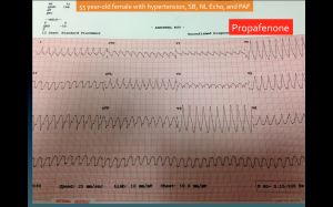 1:1 Atrial Flutter due to propafenone 